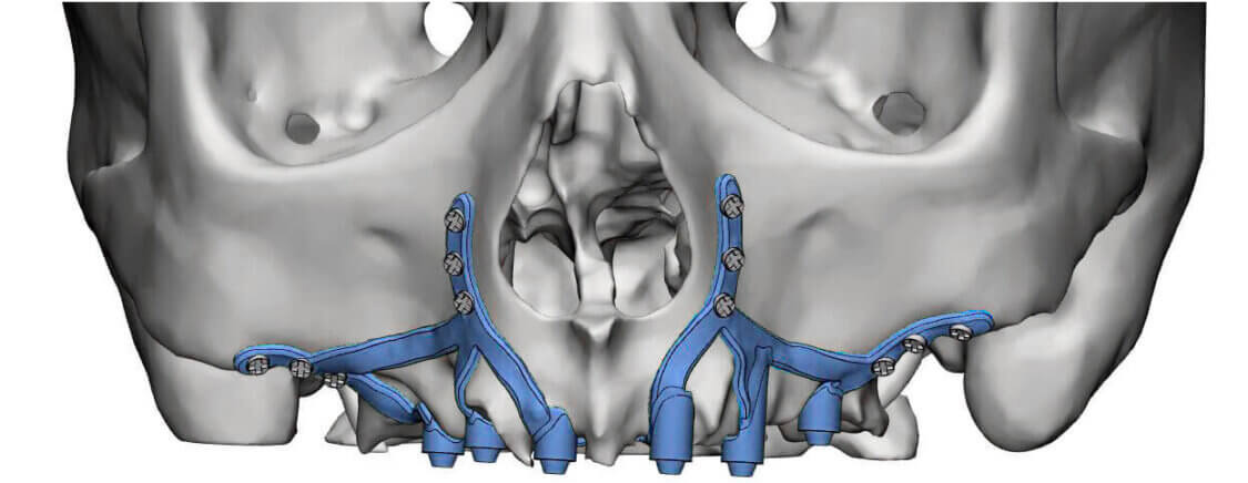 implantes subperiósticos